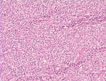 大网膜肿瘤（附免疫组化），请发表意见！图5