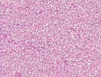 大网膜肿瘤（附免疫组化），请发表意见！图6