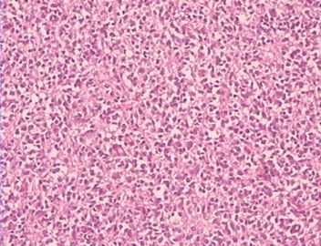 大网膜肿瘤（附免疫组化），请发表意见！图7