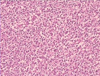 大网膜肿瘤（附免疫组化），请发表意见！图8