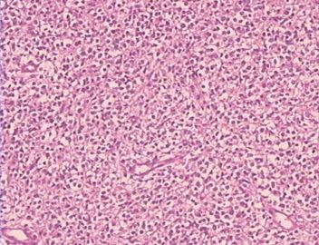 大网膜肿瘤（附免疫组化），请发表意见！图10