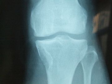 左胫骨上段肿瘤（X片已上传）图12