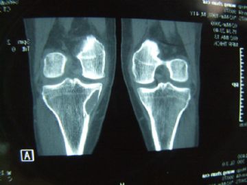 左胫骨上段肿瘤（X片已上传）图13
