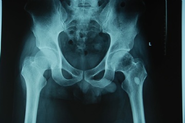 左股骨头肿瘤图1