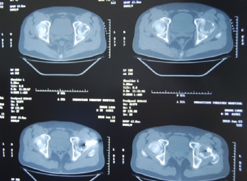左股骨头肿瘤图2