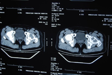 左股骨头肿瘤图3