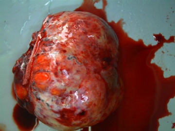 卵巢肿瘤图1