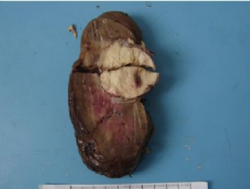 左肾肿块（中-日-澳2009墨尔本病理读片会病例2）图2