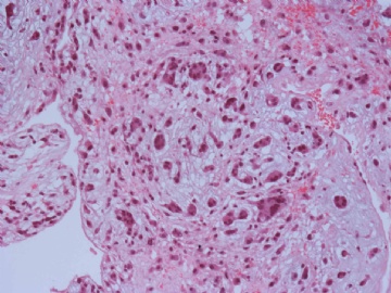 粘液瘤图片图1