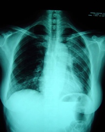 女性/51岁 纵隔-左上肺肿块2年， 3次活检诊断不明图1