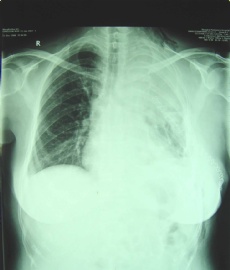 女性/51岁 纵隔-左上肺肿块2年， 3次活检诊断不明图2