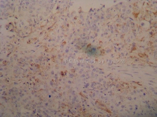 食道原位癌原位分子杂交HPV是阳性吗?图3