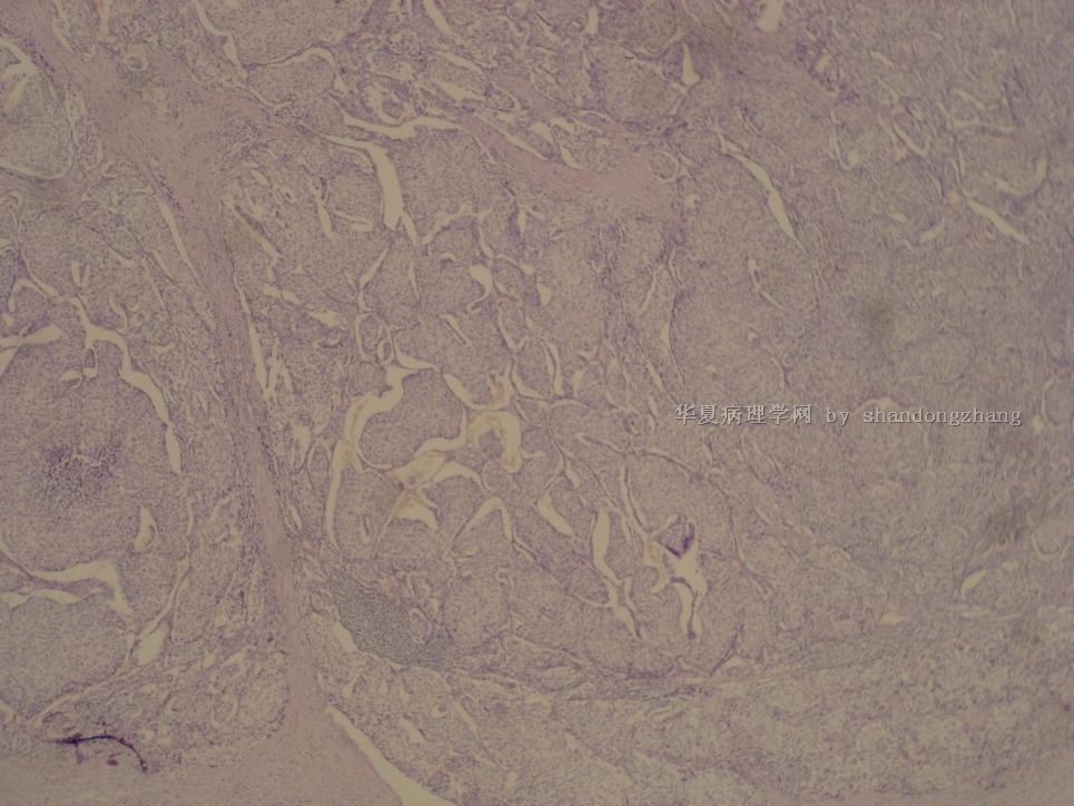 20100123-腹股沟淋巴结转移性恶性肿瘤类型或来源图8