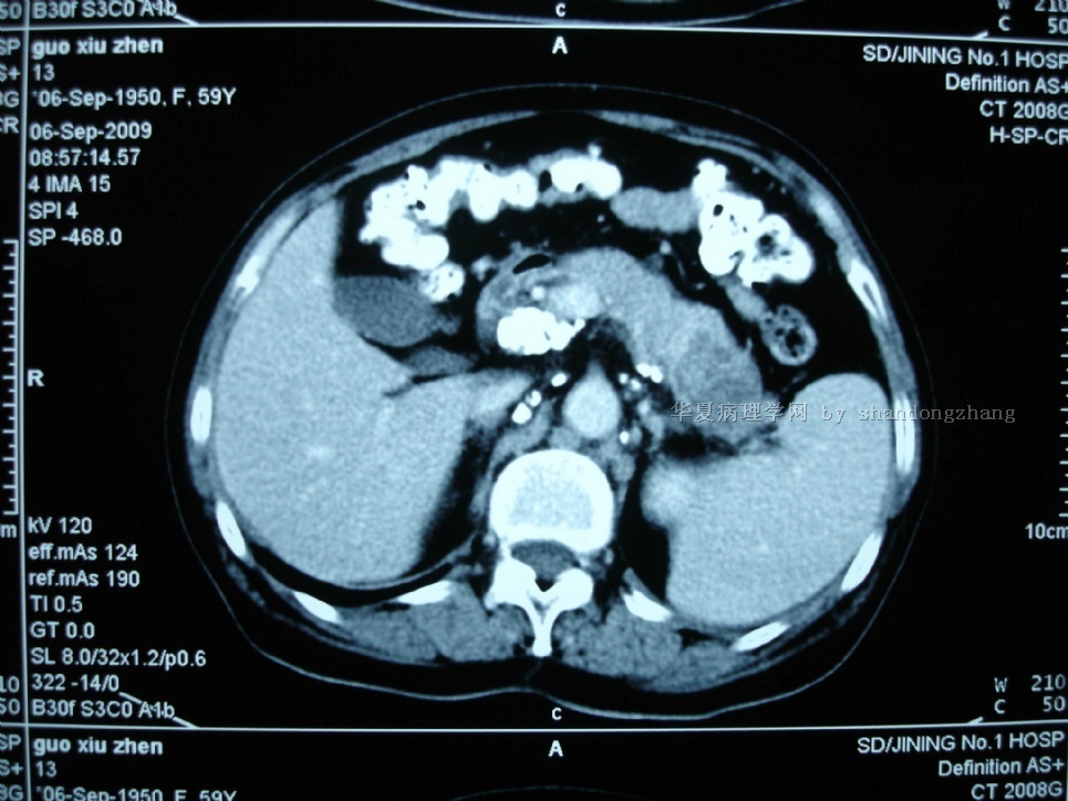 20100123-腹股沟淋巴结转移性恶性肿瘤类型或来源图13