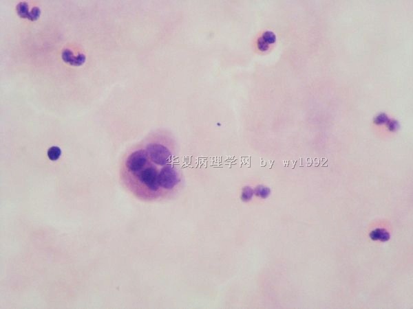 胸水中这些细胞是鳞癌吗?10/0150(363875)图3