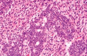 罕见病理-2 胃母细胞瘤（Gastroblastoma）图1