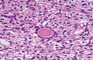 罕见病理-2 胃母细胞瘤（Gastroblastoma）图2