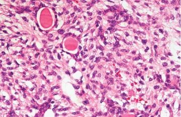 罕见病理-2 胃母细胞瘤（Gastroblastoma）图3