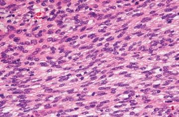 罕见病理-2 胃母细胞瘤（Gastroblastoma）图4