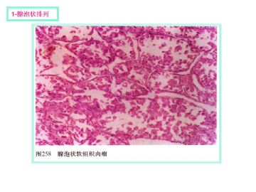 软组织肿瘤的十三种排列方式图2