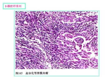 软组织肿瘤的十三种排列方式图4