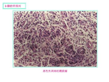 软组织肿瘤的十三种排列方式图5