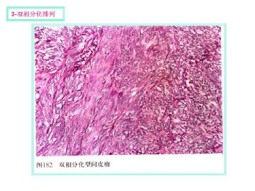 软组织肿瘤的十三种排列方式图6