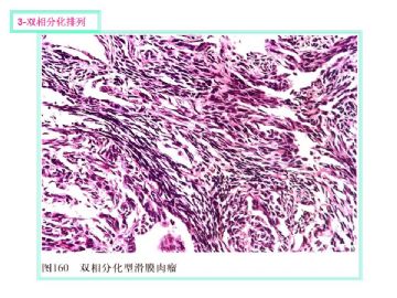 软组织肿瘤的十三种排列方式图7