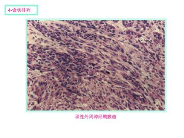 软组织肿瘤的十三种排列方式图10