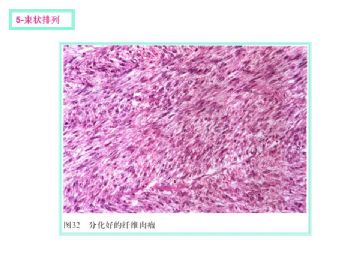 软组织肿瘤的十三种排列方式图12