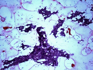 FNA of 23-year-old man right chest wall mass图1