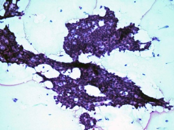 FNA of 23-year-old man right chest wall mass图2