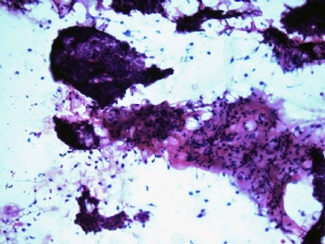 FNA of 23-year-old man right chest wall mass图3