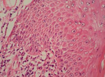 高分化鳞癌的标志-细胞间桥图2