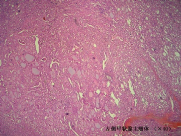 双侧甲状腺肿物（桥本合并？……该怎么报？）图3