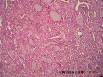 双侧甲状腺肿物（桥本合并？……该怎么报？）图4