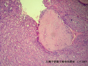 双侧甲状腺肿物（桥本合并？……该怎么报？）图9