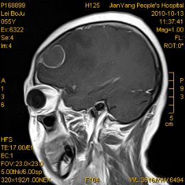 右额叶转移性鳞癌？图1