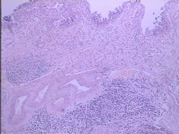 膀胱小细胞肿瘤图1