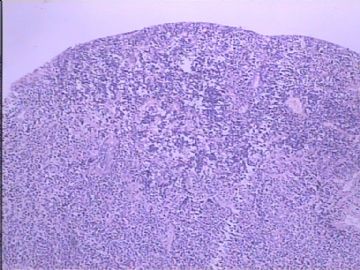 膀胱小细胞肿瘤图2