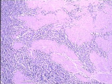 膀胱小细胞肿瘤图3