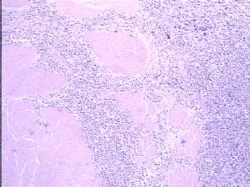 膀胱小细胞肿瘤图5