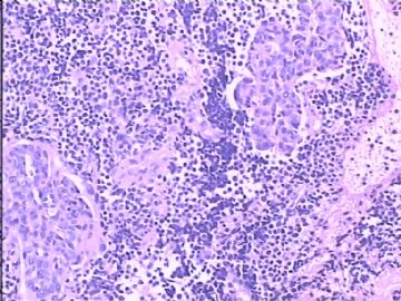 膀胱小细胞肿瘤图6
