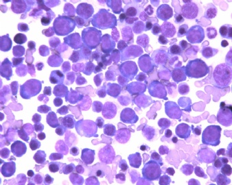 全血细胞减少，AML,细胞学分型？（20101076）图1