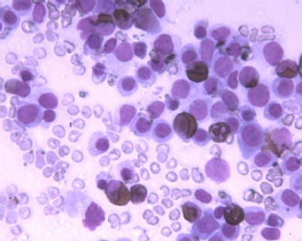 全血细胞减少，AML,细胞学分型？（20101076）图3