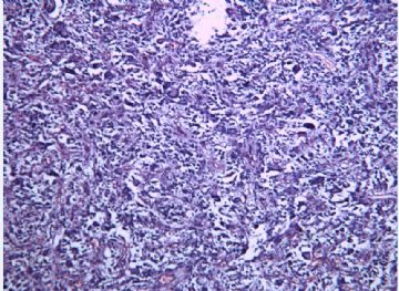 脑室占位--多形性黄色星型细胞瘤？图2