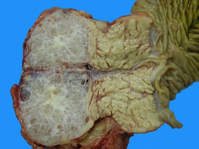 Pancreastic mass (your gross diagnosis)图1