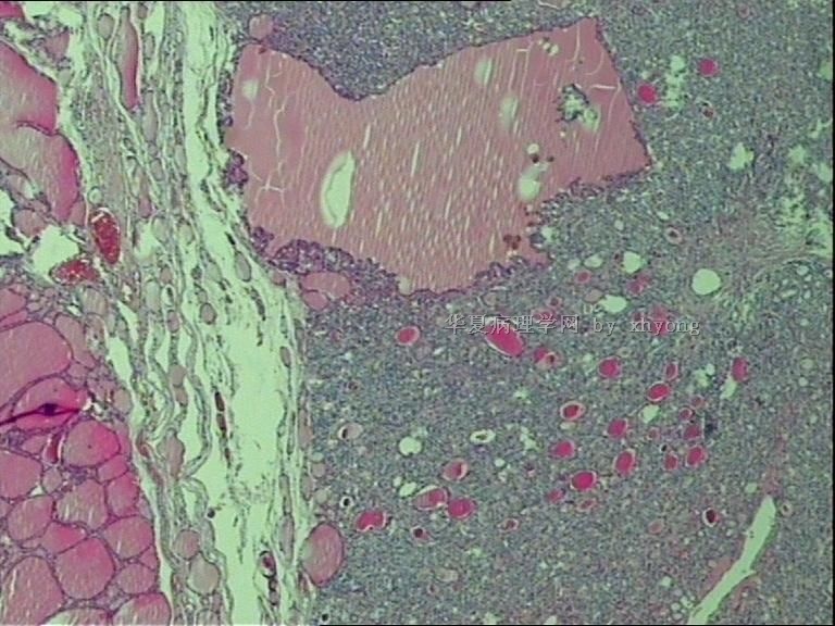 甲状腺肿物图1