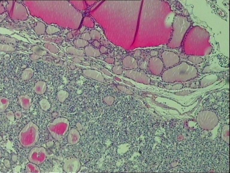 甲状腺肿物图5