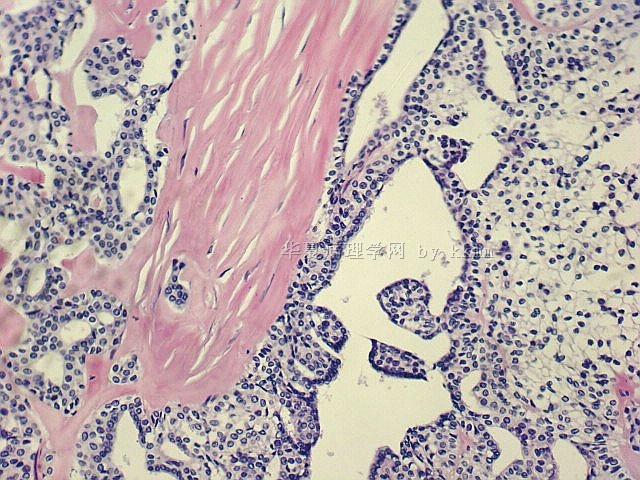 外阴透明细胞汗腺瘤图7